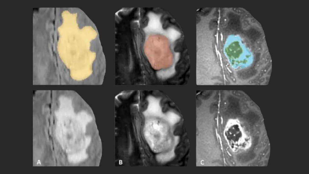 Brain Tumor Segmentation